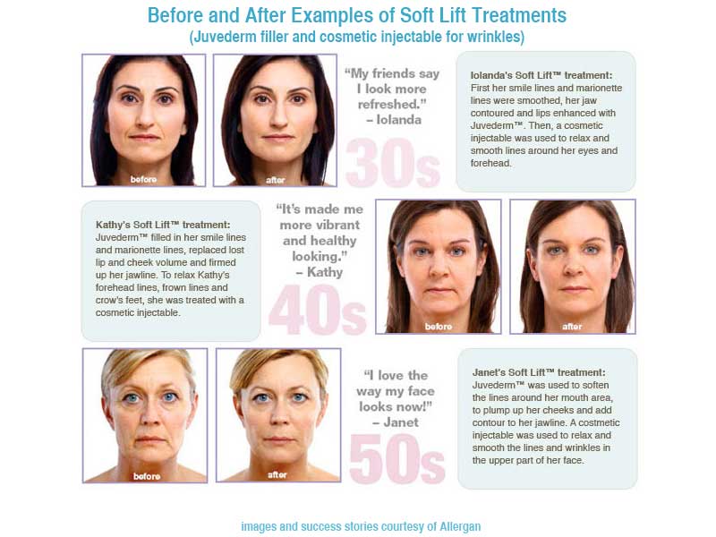 dermal fillers and cosmetic injectable great results at all ages