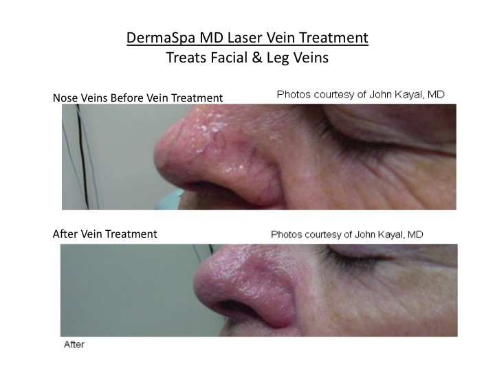 facial vein treatment