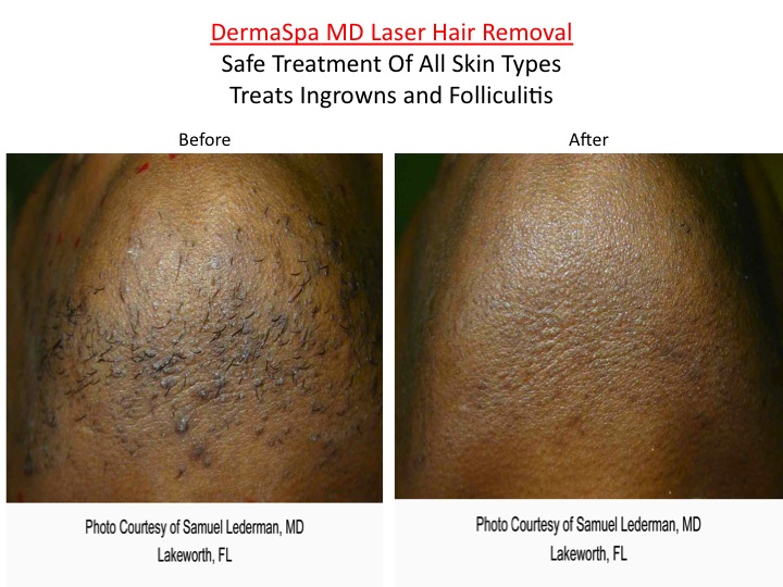 Laser Hair Removal - how to prepare for your treatment