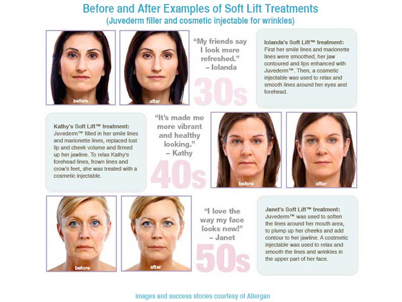 Before & After Pictures of Botox & Dermal Filler Juvederm at DermaSpa Ajax Pickering